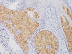 Sebaceous carcinoma stained with Adipophilin antibody