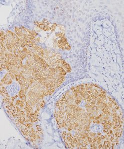Sebaceous carcinoma stained with Adipophilin antibody