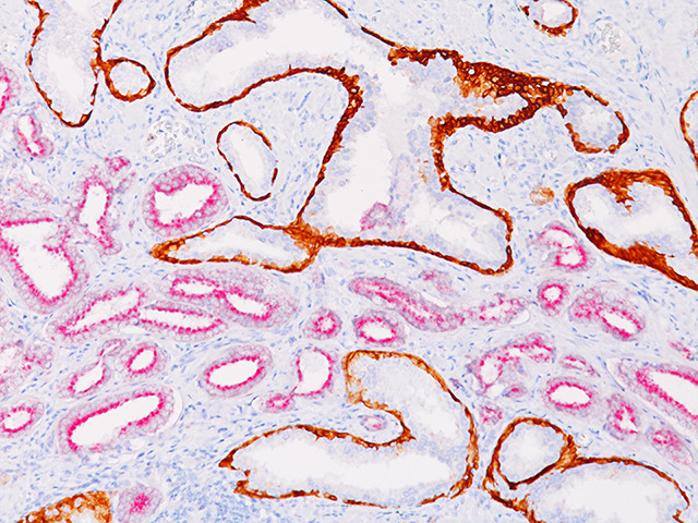 Prostate cancer stained with CK HMW + p63 + AMACR (RM)