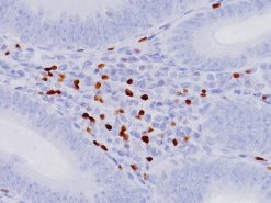 Colon cancer stained with FOXP3