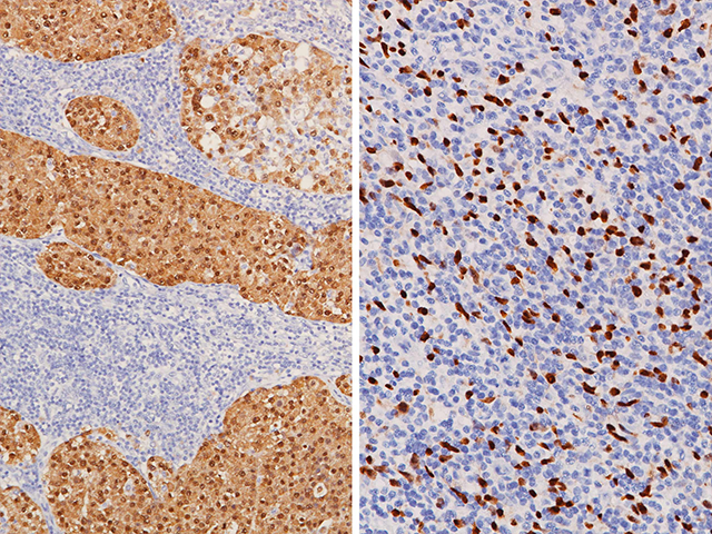 (L) Metastatic melanoma stained with MART-1 + Tyrosinase (cytoplasmic, positive) and SOX10 (nuclear, positive), (R) Melanoma stained with MART-1 + Tyrosinase (cytoplasmic, negative) and SOX10 (nuclear, positive)