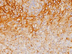 PD-L1 staining lung cancer