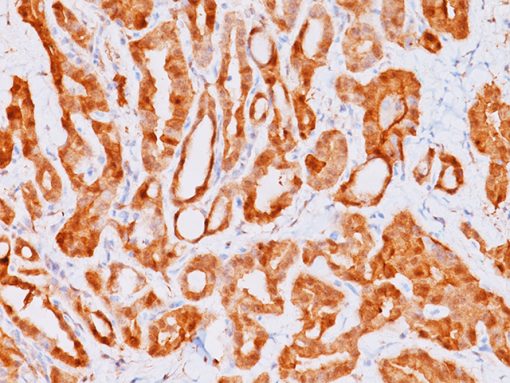 Thyroid carcinoma stained with Galectin-3