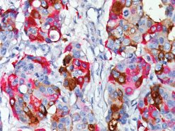 Breast cancer stained with GCDFP-15 + Mammaglobin.