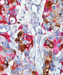 Breast cancer stained with GCDFP-15 + Mammaglobin.
