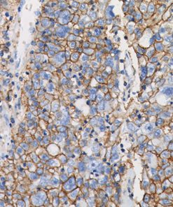 Breast cancer stained with CD44 (HCAM) Antibody