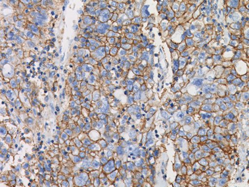 Breast cancer stained with CD44 (HCAM) Antibody