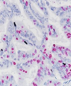 Colon cancer stained with Ki-67 (red) + pHH3 (black).