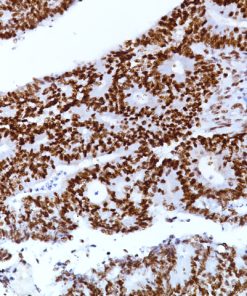 Colorectal carcinoma stained with MLH-1 [BC23]
