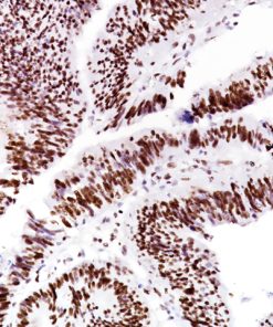 Colorectal carcinoma stained with MSH6 [BC19]
