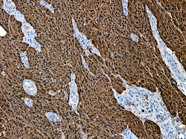 Melanoma Stained with S100 Protein [4C4.9] (M)