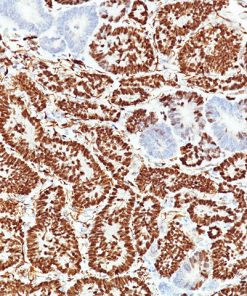 Wilms' tumor stained with WT1 [rWT1/857] Antibody.