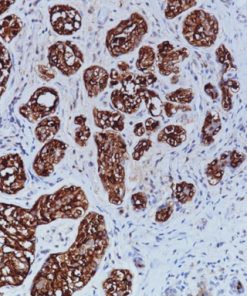 Breast cancer stained with BCA-225 [Cu-18] antibody