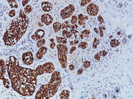 Breast cancer stained with BCA-225 [Cu-18] antibody