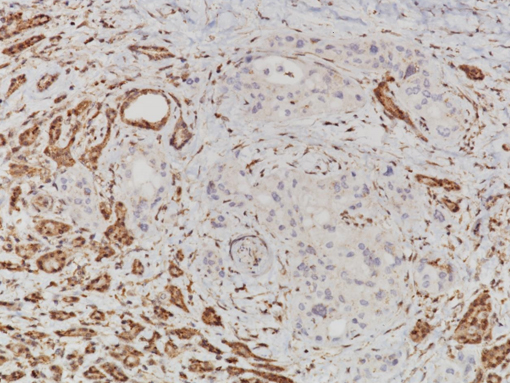 Loss of SMAD4 [EP618Y] antibody on pancreatic cancer tissue