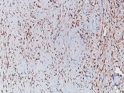 Solitary fibrous tumor stained with STAT6 [YE361] antibody