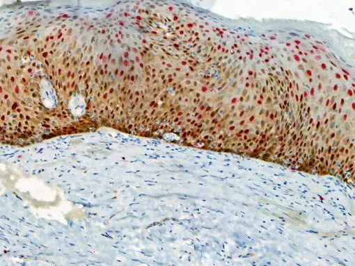 Cervix stained with p16 + Ki-67