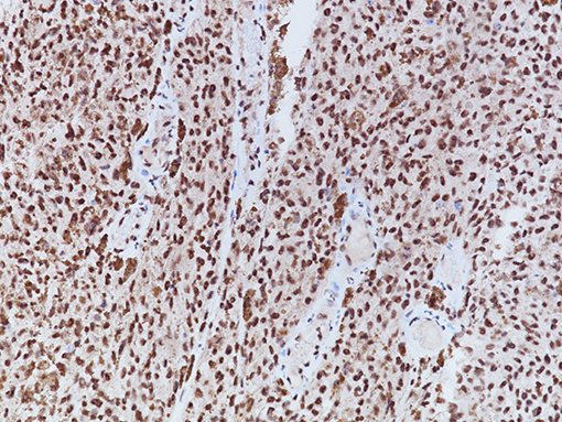 Melanoma stained with BAP1 Antibody