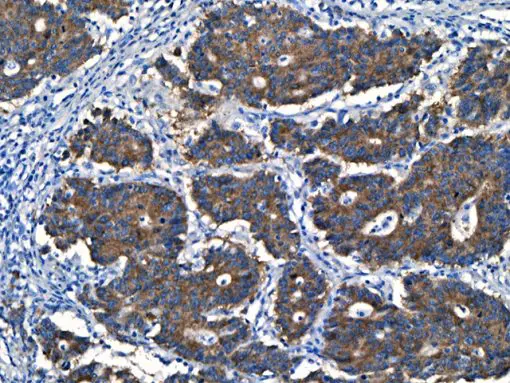 Colon Ca stained with BRAF V600E [VE1] antibody