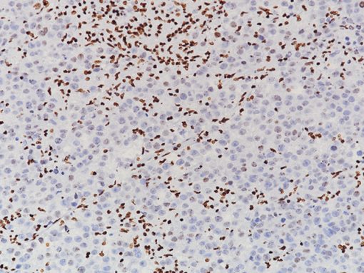 Ovarian cancer stained with H3K27me3 [C36B11] antibody