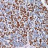 Breast cancer stained with Ki-67 Rabbit antibody