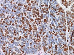 Breast cancer stained with Ki-67 Rabbit antibody