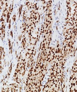 Melanoma stained with PRAME [EPR20330] antibody