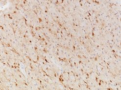 Astrocytoma stained with IDH1 R132H [IHC132] antibody