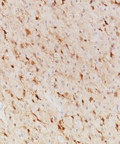 Astrocytoma stained with IDH1 R132H [IHC132] antibody