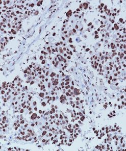 Breast carcinoma stained with PCNA [PC10] antibody