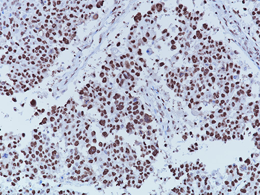 Breast carcinoma stained with PCNA [PC10] antibody