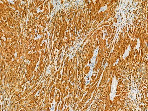 Metastatic melanoma stained with p16 (DAB)