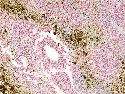 Non-metastatic melanoma stained with PRAME (Red)