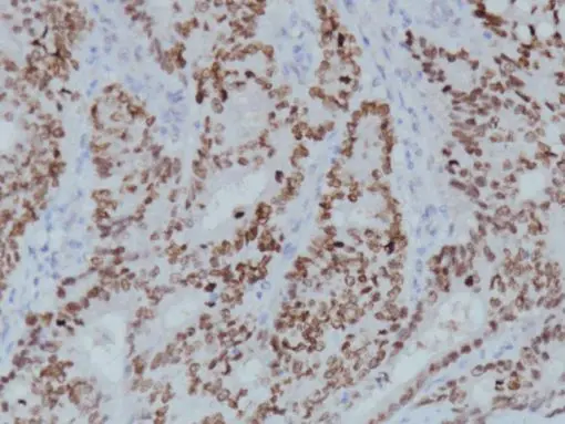 Colon cancer stained with SATB2 [CL0323] antibody