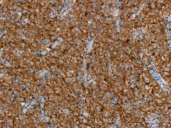 Diffuse astrocytoma stained with PAN TRK [RM423] antibody