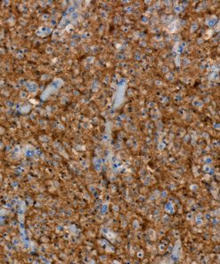 Diffuse astrocytoma stained with PAN TRK [RM423] antibody