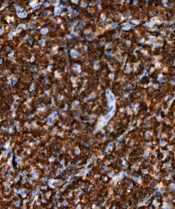 Lymphoma stained with CD247 [BL-336-1B2] antibody