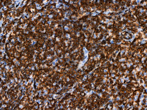 Lymphoma stained with CD247 [BL-336-1B2] antibody