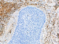 Lung cancer stained with VISTA [BLR035F] antibody