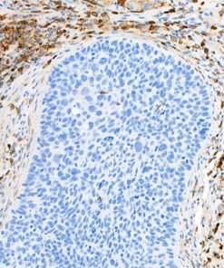 Lung cancer stained with VISTA [BLR035F] antibody