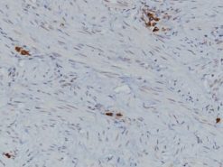 Endometrial cancer stained with Mast Cell Tryptase [AA1] antibody