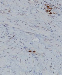 Endometrial cancer stained with Mast Cell Tryptase [AA1] antibody