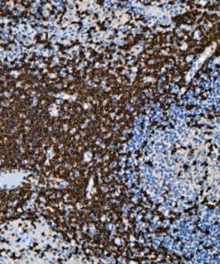T-cell lymphoma stained with TRBC1 antibody.