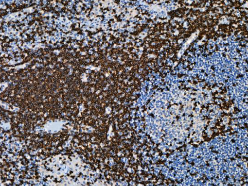 T-cell lymphoma stained with TRBC1 antibody.