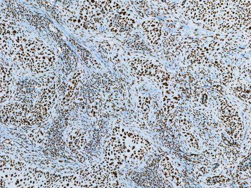 Melanoma stained with NPM1 antibody