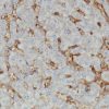 Liver cancer stained with CD47 [EPR21794] antibody
