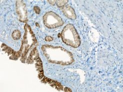 Gall bladder cancer stained with CA-9 antibody