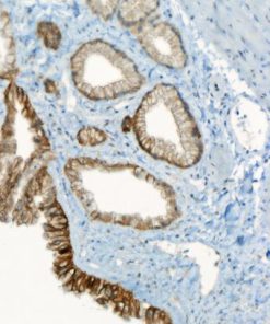 Gall bladder cancer stained with CA-9 antibody