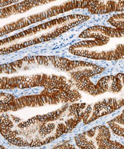Stomach cancer stained with CA-9 antibody