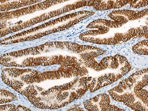 Stomach cancer stained with CA-9 antibody